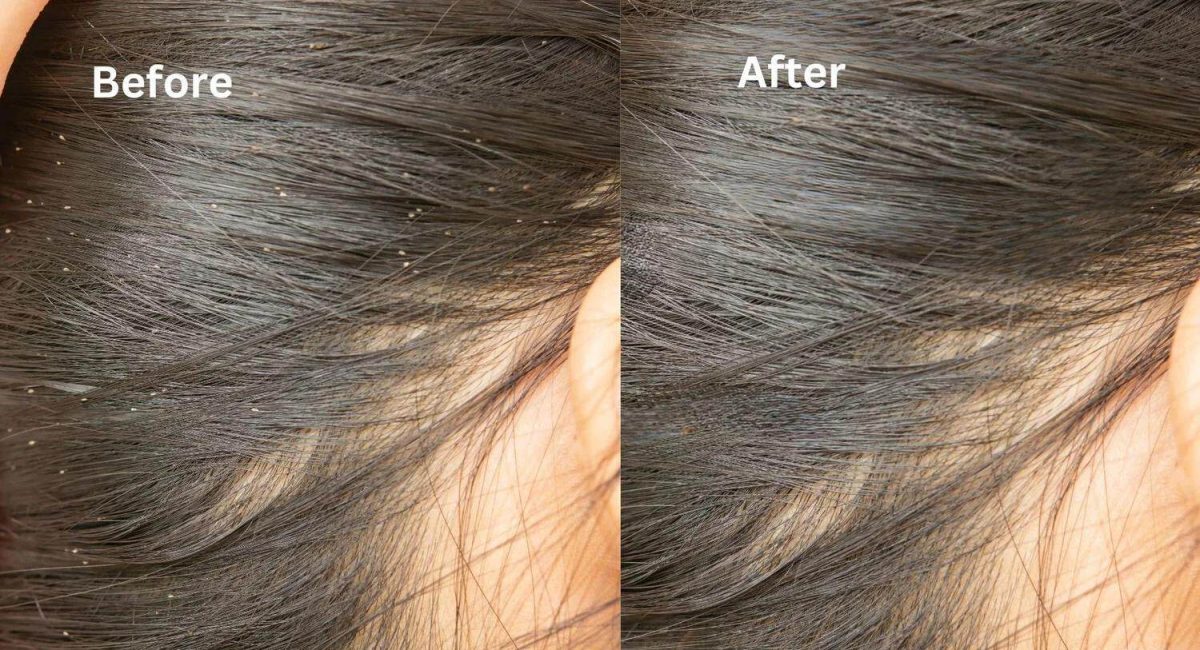 Before after lice treatment in beaueteck